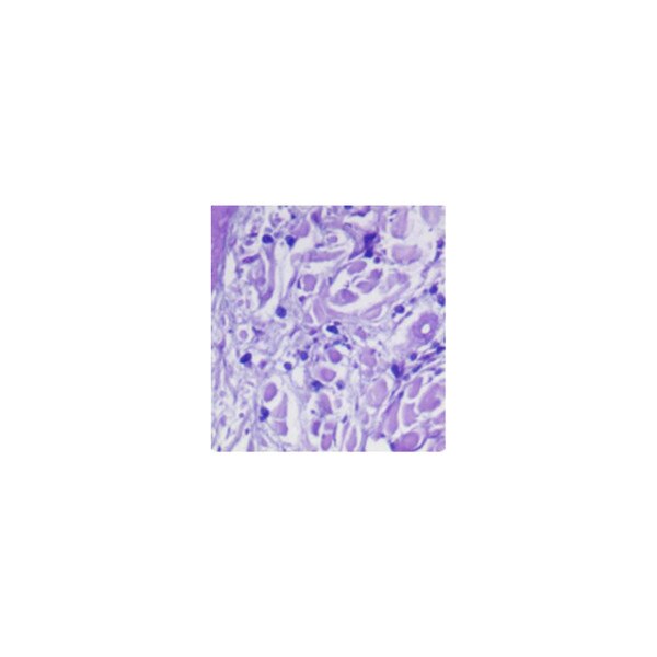 Combined Eosinophil-Mast